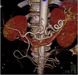 Excellent Example of High Opacity VRT to Define Mesenteric Arteries- See Full Sequence - CTisus CT Scan