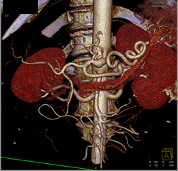 Excellent Example of High Opacity VRT to Define Mesenteric Arteries- See Full Sequence - CTisus CT Scan