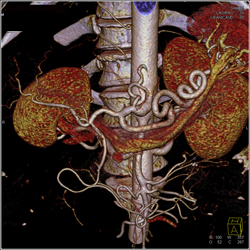 Excellent Example of High Opacity VRT to Define Mesenteric Arteries- See Full Sequence - CTisus CT Scan