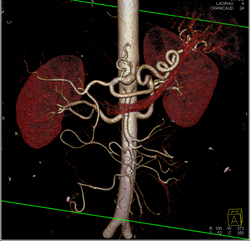 Excellent Example of High Opacity VRT to Define Mesenteric Arteries- See Full Sequence - CTisus CT Scan