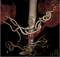 Excellent Example of High Opacity VRT to Define Mesenteric Arteries- See Full Sequence - CTisus CT Scan