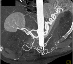 Excellent Example of High Opacity VRT to Define Mesenteric Arteries- See Full Sequence - CTisus CT Scan