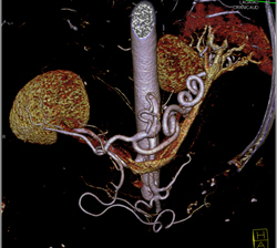 Excellent Example of High Opacity VRT to Define Mesenteric Arteries- See Full Sequence - CTisus CT Scan