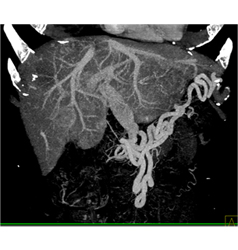 Islet Cell Tumor Invades the Portal Vein With Collaterals - CTisus CT Scan