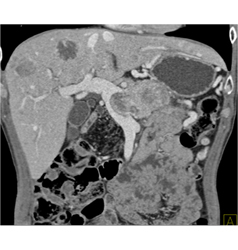 Islet Cell Tumor Invades the Portal Vein With Collaterals - CTisus CT Scan