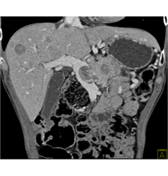 Islet Cell Tumor Invades the Portal Vein With Collaterals - CTisus CT Scan