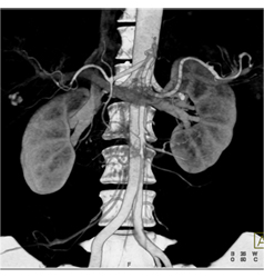 Subtle Islet Cell Tumor of the Body of the Pancreas - CTisus CT Scan