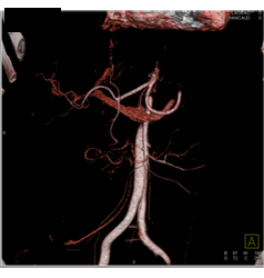 Subtle Islet Cell Tumor of the Body of the Pancreas - CTisus CT Scan