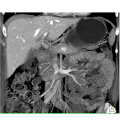 Subtle Islet Cell Tumor of the Body of the Pancreas - CTisus CT Scan