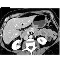 Subtle Islet Cell Tumor of the Body of the Pancreas - CTisus CT Scan