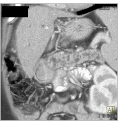 Post Whipple Procedure - CTisus CT Scan