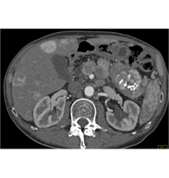 Calcified Islet Cell Tumor With Liver Metastases - CTisus CT Scan