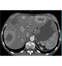 Calcified Islet Cell Tumor With Liver Metastases - CTisus CT Scan