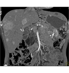 Calcified Islet Cell Tumor With Liver Metastases - CTisus CT Scan