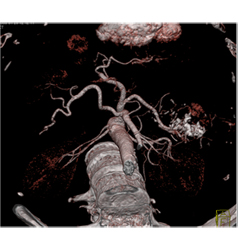 Calcified Islet Cell Tumor With Liver Metastases - CTisus CT Scan