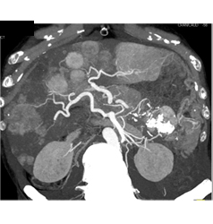 Calcified Islet Cell Tumor With Liver Metastases - CTisus CT Scan