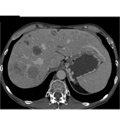 Calcified Islet Cell Tumor With Liver Metastases - CTisus CT Scan