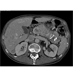 Islet Cell Tumor With Liver Metastases and Invasion of the Portal Vein - CTisus CT Scan