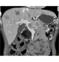 Islet Cell Tumor With Liver Metastases and Invasion of the Portal Vein - CTisus CT Scan