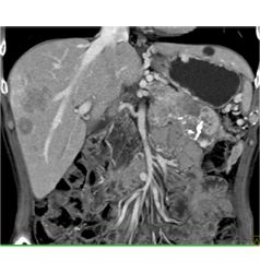 Islet Cell Tumor With Liver Metastases and Invasion of the Portal Vein - CTisus CT Scan