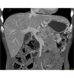 Islet Cell Tumor With Liver Metastases and Invasion of the Portal Vein - CTisus CT Scan