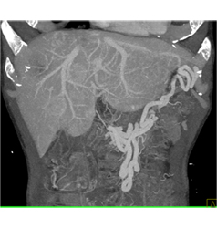 Islet Cell Tumor With Liver Metastases and Invasion of the Portal Vein - CTisus CT Scan