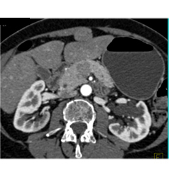 Adenocarcinoma Obstructs the Pancreatic Duct With Implants - CTisus CT Scan