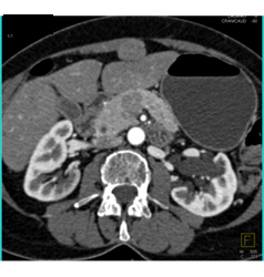 Adenocarcinoma Obstructs the Pancreatic Duct With Implants - CTisus CT Scan