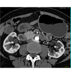 Adenocarcinoma Obstructs the Pancreatic Duct With Implants - CTisus CT Scan