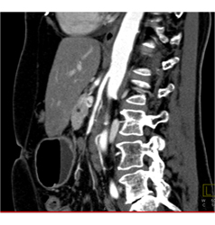 Adenocarcinoma Obstructs the Pancreatic Duct With Implants - CTisus CT Scan