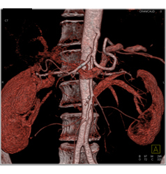 Adenocarcinoma Obstructs the Pancreatic Duct With Implants - CTisus CT Scan