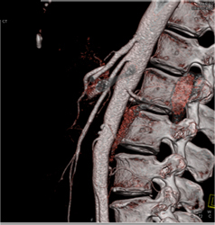 Adenocarcinoma Obstructs the Pancreatic Duct With Implants - CTisus CT Scan