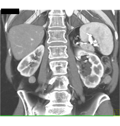 Adenocarcinoma Obstructs the Pancreatic Duct With Implants - CTisus CT Scan