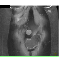 Adenocarcinoma Obstructs the Pancreatic Duct With Implants - CTisus CT Scan