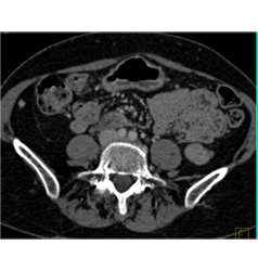 Adenocarcinoma Obstructs the Pancreatic Duct With Implants - CTisus CT Scan