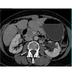 Adenocarcinoma Obstructs the Pancreatic Duct With Implants - CTisus CT Scan