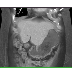 Adenocarcinoma Obstructs the Pancreatic Duct With Implants - CTisus CT Scan