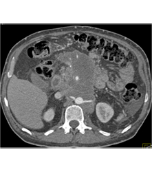 Pancreatic Cancer Invades the SMA/celiac and PV/SMV - CTisus CT Scan