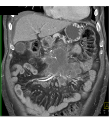 Pancreatic Cancer Invades the SMA/celiac and PV/SMV - CTisus CT Scan