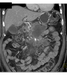 Pancreatic Cancer Invades the SMA/celiac and PV/SMV - CTisus CT Scan