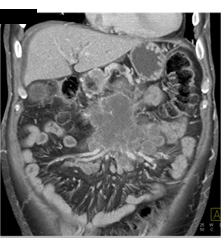 Pancreatic Cancer Invades the SMA/celiac and PV/SMV - CTisus CT Scan