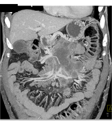 Pancreatic Cancer Invades the SMA/celiac and PV/SMV - CTisus CT Scan