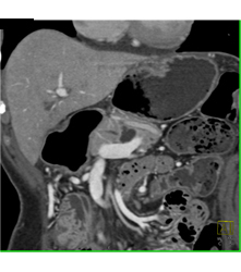 Intraductal Papillary Mucinous Neoplasm (IPMN) - CTisus CT Scan