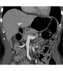 Intraductal Papillary Mucinous Neoplasm (IPMN) - CTisus CT Scan