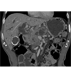 Pancreatic Cancer Obstructs the Common Bile Duct (CBD) - CTisus CT Scan