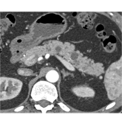 Multiple Intraductal Papillary Mucinous Neoplasms (IPMNs) - CTisus CT Scan