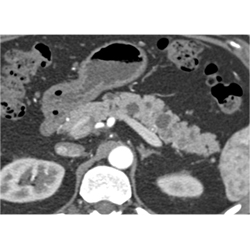 Multiple Intraductal Papillary Mucinous Neoplasms (IPMNs) - CTisus CT Scan