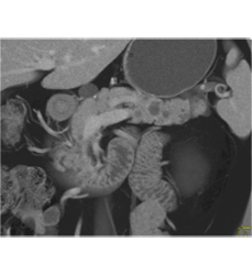 Multiple Intraductal Papillary Mucinous Neoplasms (IPMNs) - CTisus CT Scan