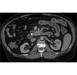 Carcinoma of the Uncinate Process - CTisus CT Scan