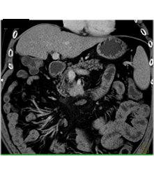 Carcinoma of the Uncinate Process - CTisus CT Scan